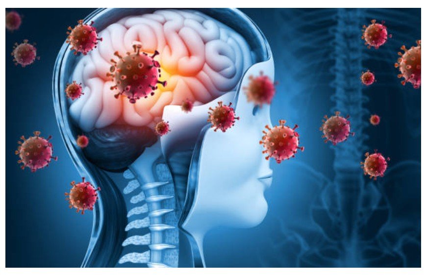 Mato Grosso registra 28 casos confirmados e seis mortes por meningite em 2026; Duas em Sorriso