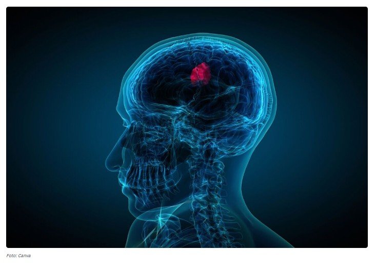 Tumor cerebral exige atenção aos sintomas para aumentar as chances de tratamento