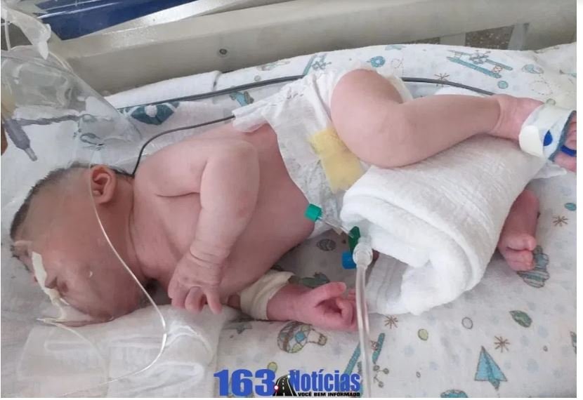 Bebê que aguardava cirurgia por ter nascido com malformação morre com Covid-19 em MT