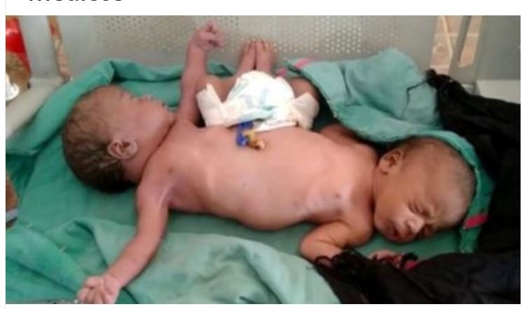 Gêmeas siamesas nascem com duas pernas e quatro braços e desafiam médicos