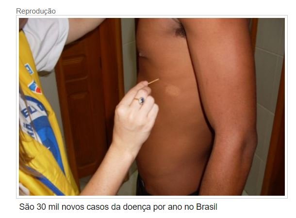 Janeiro é mês de conscientização sobre a hanseníase