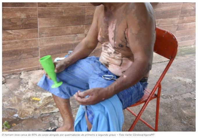 Homem tem grande parte do corpo queimado ao colocar álcool em fogareiro
