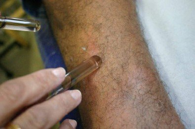 MT ocupa 2º lugar em casos de hanseníase