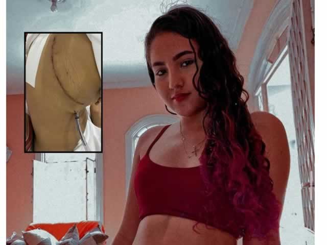 Jovem de 19 anos contrai fungos no pulmão por uso de narguilé e passa por cirurgia em Cuiabá