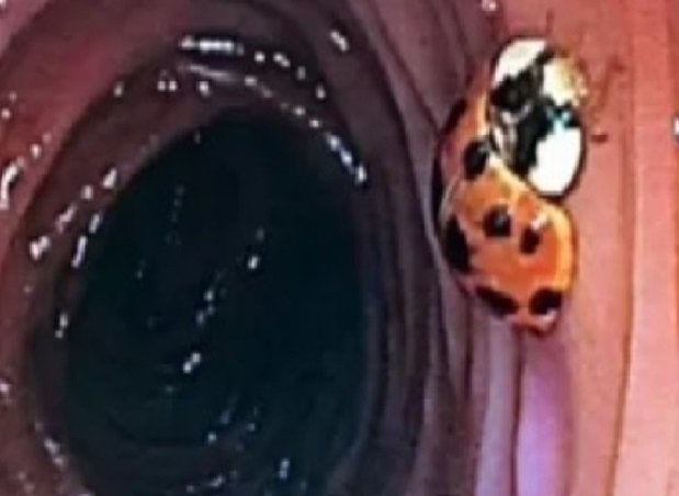 Homem faz colonoscopia e descobre joaninha vivendo em seu intestino
