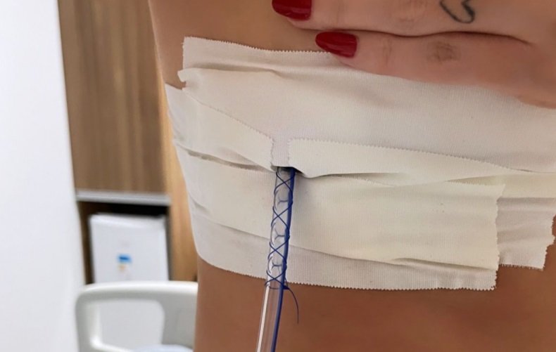 Massagista perfura pulmões de paciente com agulhas de acupuntura