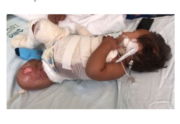 Bebê morre em hospital após ter 80% do corpo queimado