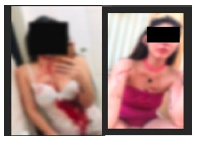 Dançarina diz que cortou o próprio pescoço após ser agredida por jogador