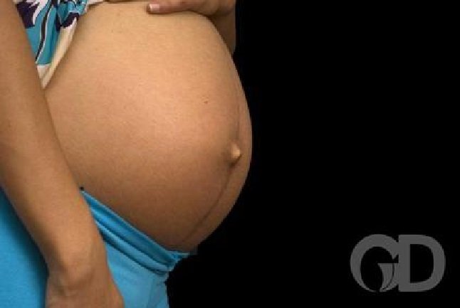 Grávida de gêmeos diz ter recebido somente um bebê após o parto