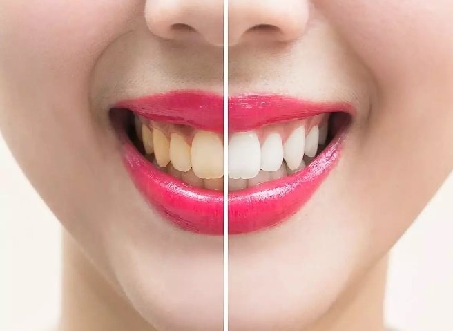 Óleo de coco natural clareia os dentes? Aprenda agora como é feito esse processo