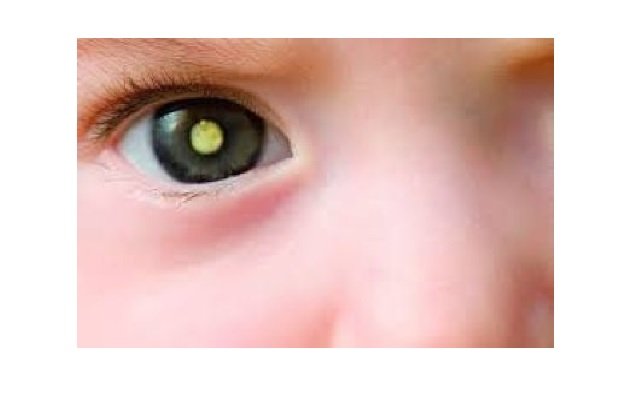 Lei garante tratamento para retinoblastoma em MT