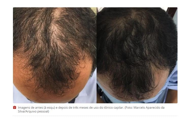 Após pesquisa de 30 anos, UFMG desenvolve cosmético que combate a queda capilar e ajuda no crescimento de novos fios