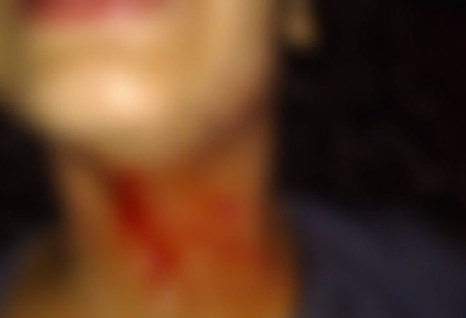Criança quase morre ao ter pescoço cortado com linha de pipa com cerol em MT