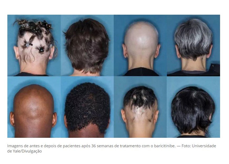 Baracitinibe, remédio contra artrite, Covid e dermatite, passa agora a ser indicado para tratar queda de cabelo