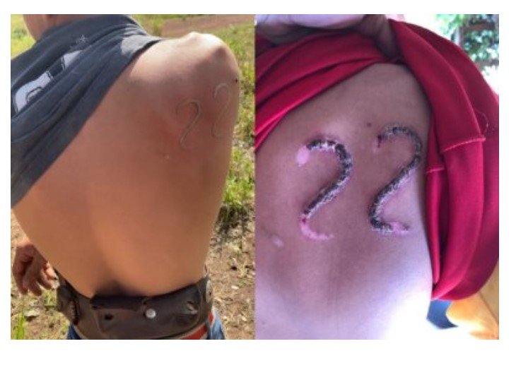 Jovem de MT usa carimbo de gado para tatuar costas com 22 de Bolsonaro
