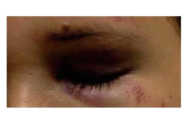 Jovem é espancada por ex-namorado após não querer reatar namoro