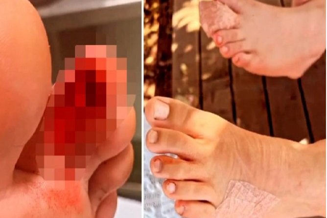 Duas crianças são atacadas por piranhas em MT