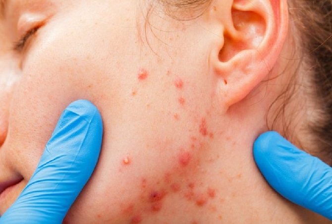 7 truques diários para lidar com as acnes