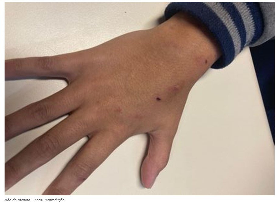 Menino de 11 anos procura agentes para denunciar mãe por agressão com panela quente