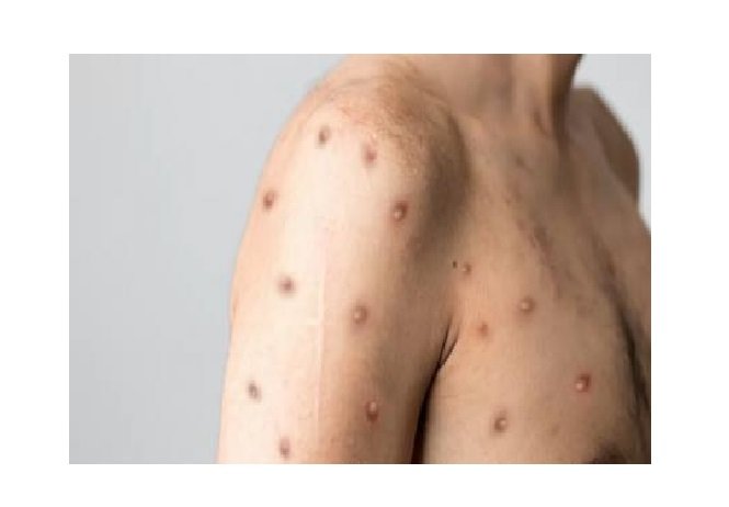 6 novos casos de mokeypox são notificados em Mato Grosso