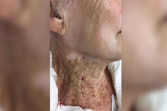 Estudo analisa pele de idosa que, por 40 anos, usou filtro solar só no rosto