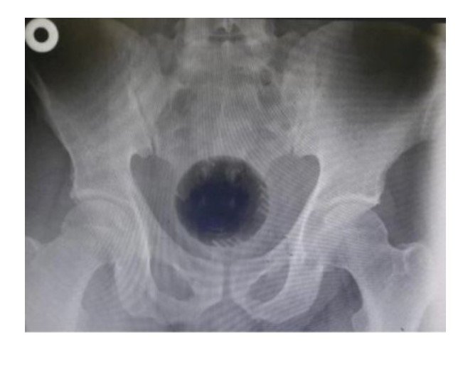 Homem passa por cirurgia para retirar bola de 7 cm presa no ânus