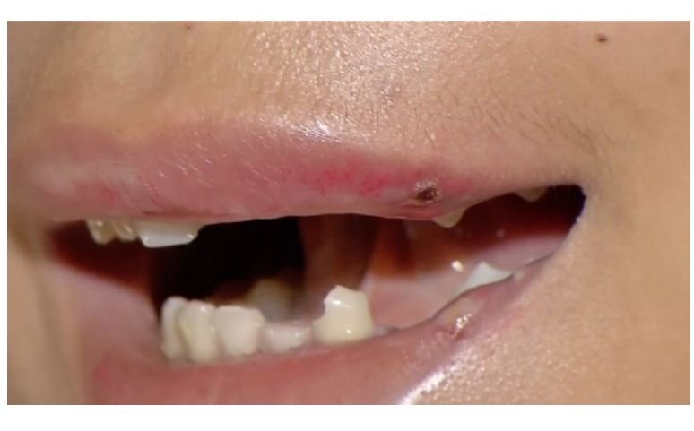 Travesti de 15 anos é espancada e tem oito dentes quebrados