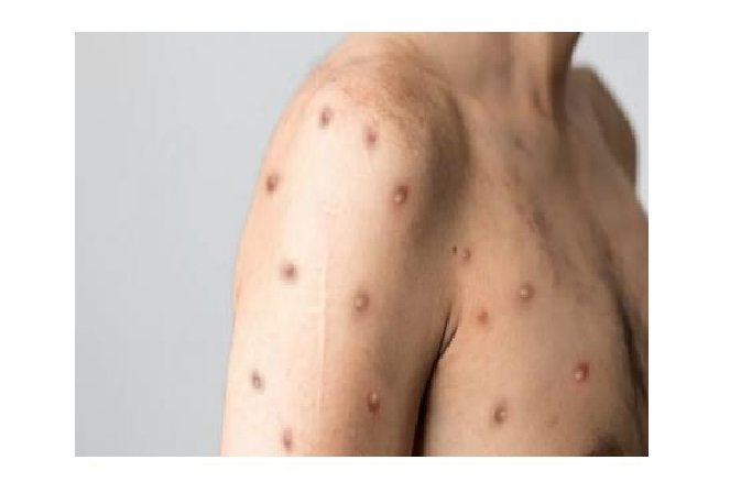 Sobe para 59 número de casos de monkeypox em Mato Grosso