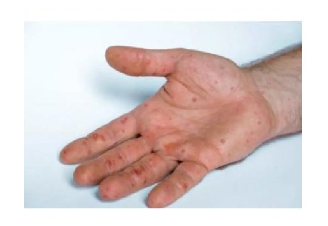Fim de semana registra 9 novos casos de monkeypox em MT