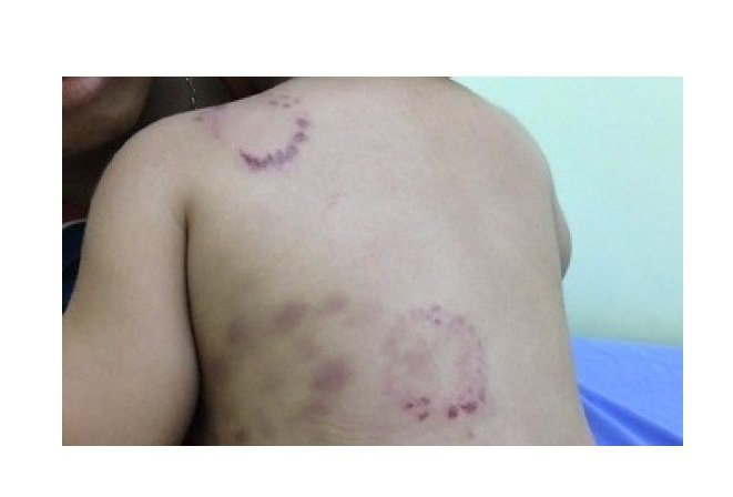 Criança vai parar em UPA com mordidas e cicatrizes feitas por padrasto