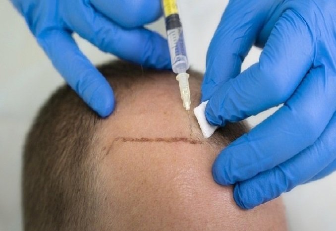 Queda de cabelo e calvície podem estar com os dias contados; entenda