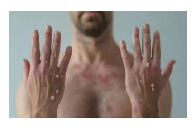 MT registra primeira morte por Monkeypox: vítima era homem de 27 anos