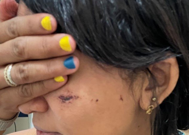 Mulher sai em Colíder para se divertir com jogo do Brasil e acaba agredida e com corte no rosto em choperia.