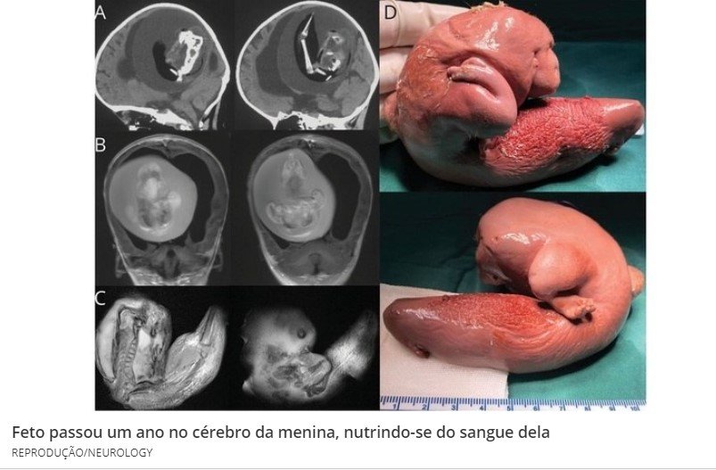 Bebê de 1 ano tinha feto de irmã gêmea alojado no cérebro