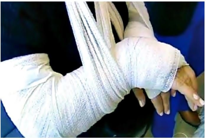Mulher é agredida pelo companheiro e tem braço quebrado e luxação na costela