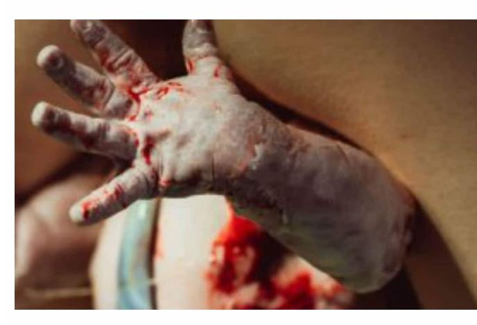Foto mostra bebê nascendo sentado e impressiona a web! VEJA: