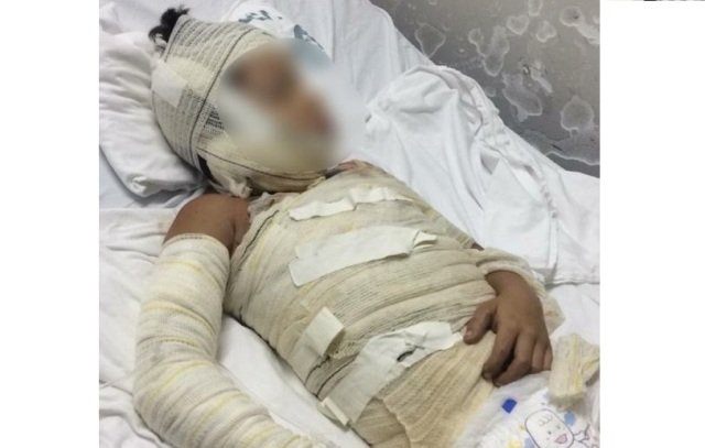 Menino de 8 anos tem 45% do corpo queimado após irmão tentar fazer pipoca em fogão improvisado