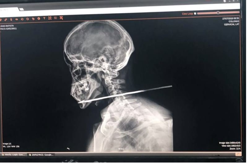 Brasileiro é atingido por flechada no pescoço ao tentar passar fronteira