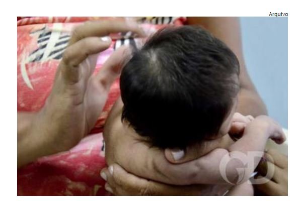 Mato Grosso notificou 427 casos de microcefalia desde 2015