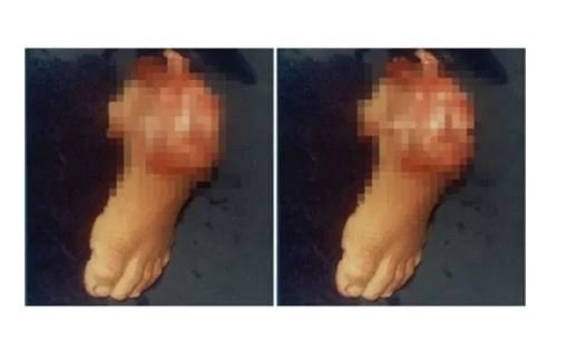 Mãe amputa o pé do filho de 3 anos com machado para receber seguro do INSS