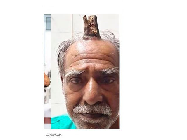 Homem tem 'chifre' de 10cm removido em cirurgia; veja fotos