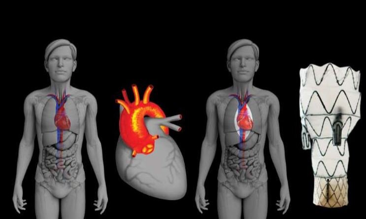 Invenção de brasileiro pode revolucionar cirurgia cardíaca