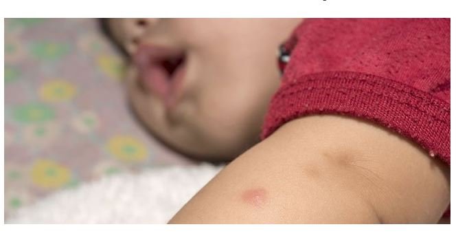 Bebê de seis meses é mordido no rosto por cachorro em Colíder.