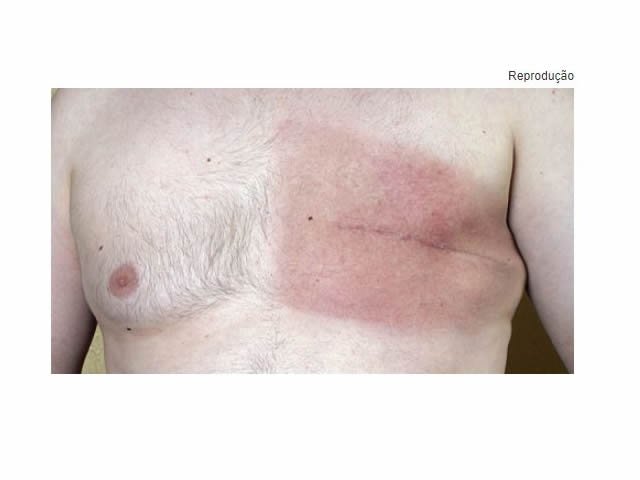 Câncer de mama em homens requer atenção aos sintomas