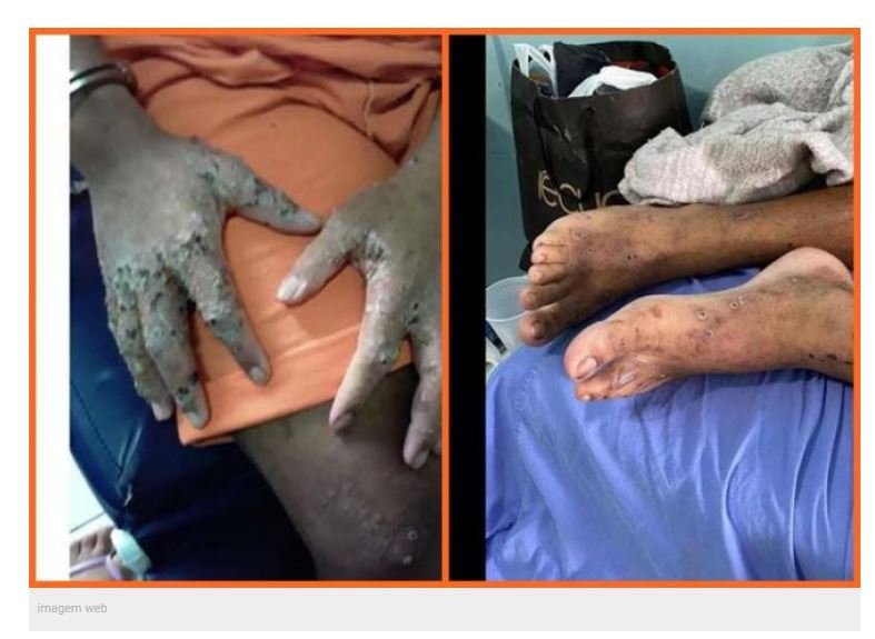 Detentos são COMIDOS VIVOS por bactéria desconhecida em Roraima