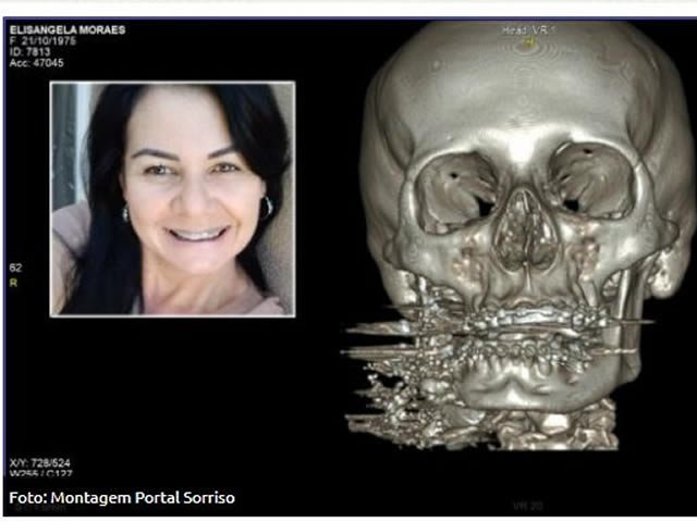 Sorriso: advogado aponta que policial só não matou vítima por falta de munição; mulher passa por cirurgia