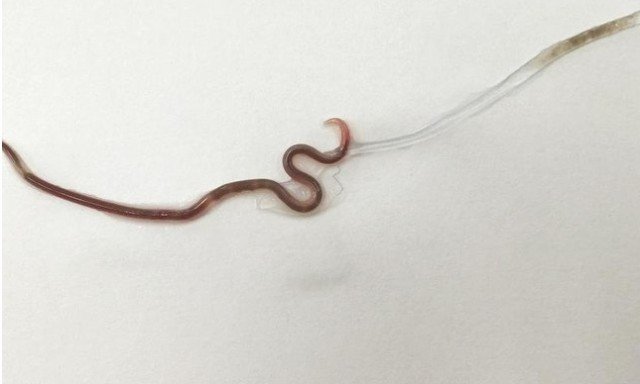 Lombriga é retirada de garganta de mulher após ela comer sashimi
