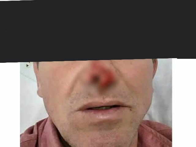 Homem em Colíder leva mordidas no nariz apos ser agredido pela mulher.