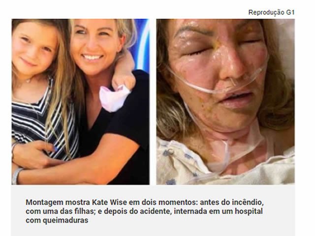 Mulher tem corpo parcialmente queimado após álcool gel pegar fogo