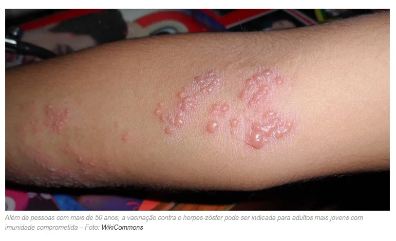 Vacinação contra herpes-zóster é fundamental para prevenir a doença na terceira idade